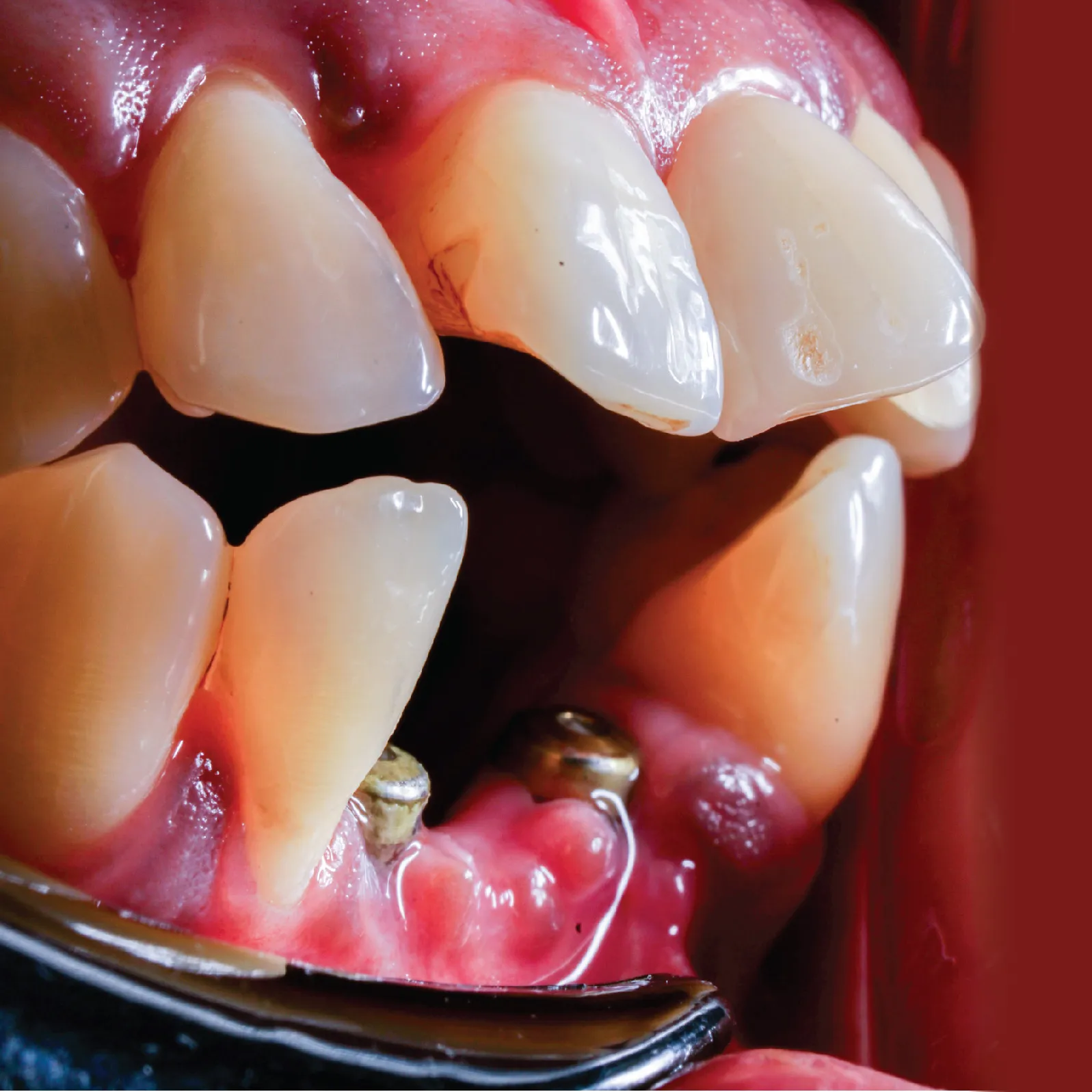 fotos-dental-implante-11_11zon